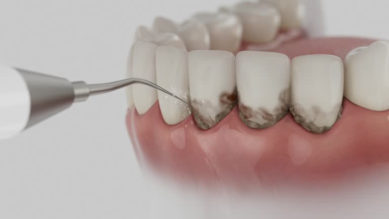Trusted Wisdom Tooth Removal service in Erda, UT - Dentist Open Now